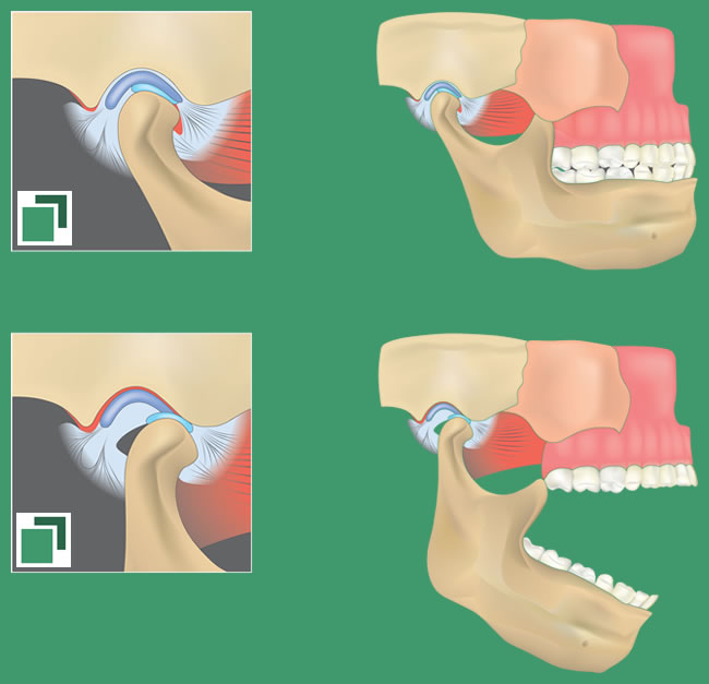 Die Behandlung einer CMD erfordert individuelle Konzepte.